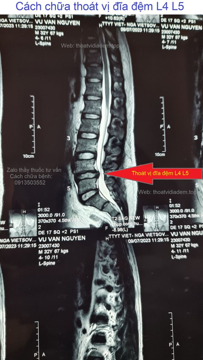 Cách chữa thoát vị đĩa đệm L4 L5